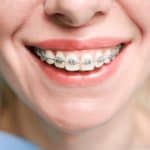 Las mejores clínicas para ponerte brackets en Barcelona